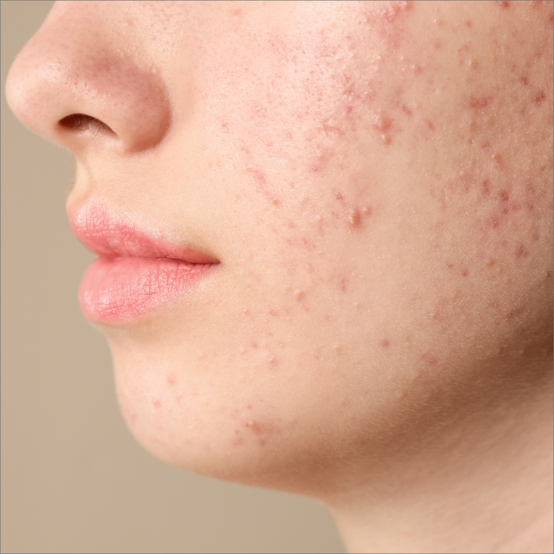 Clear Skin Acne Facial