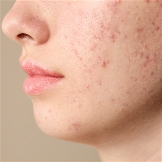 Clear Skin Acne Facial